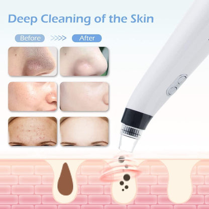 Blackhead Remover Device